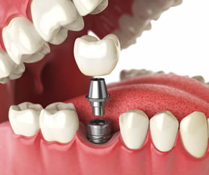 Link to more info about Advantages of Implant Dentistry